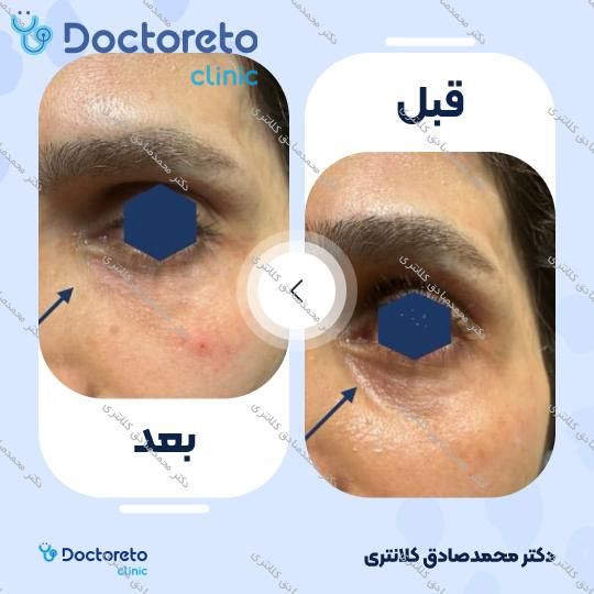 تزریق ژل زیر چشم