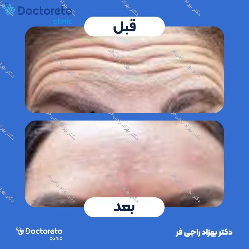 تزریق بوتاکس صورت (پیشانی، خط اخم، پنجه کلاغی)