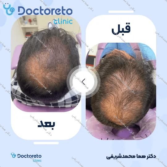 جوانسازی و روشن سازی سیاهی دور چشم با روش پلاسما تراپی