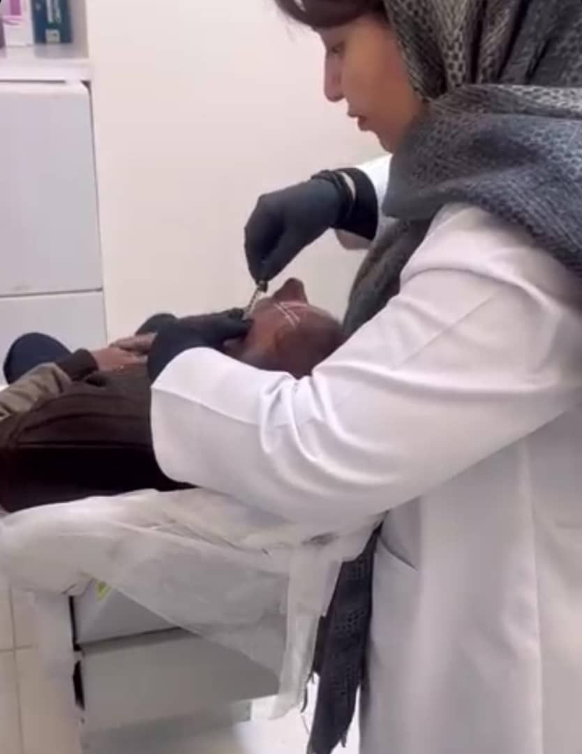 تزریق بوتاکس صورت (پیشانی، خط اخم، پنجه کلاغی)💉