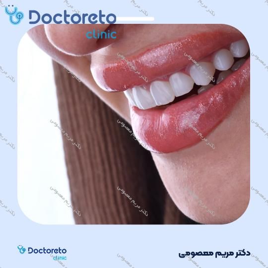 لمینت دندان (هر واحد)