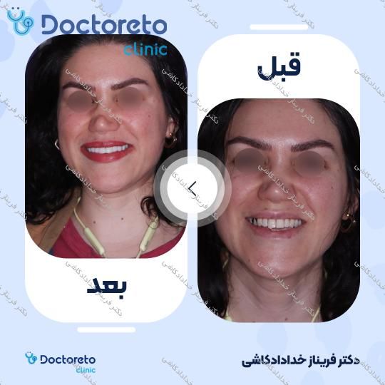 ونیر کامپوریت (هر واحد)