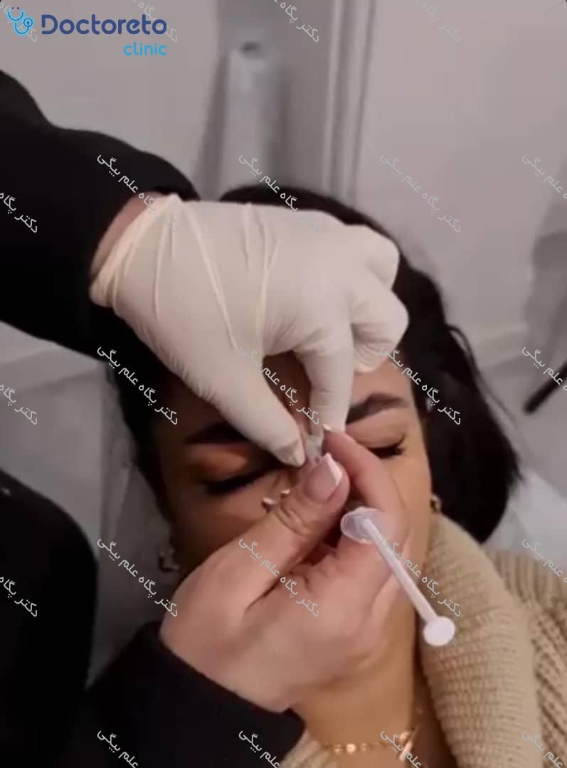 تزریق بوتاکس صورت (پیشانی، خط اخم، پنجه کلاغی)