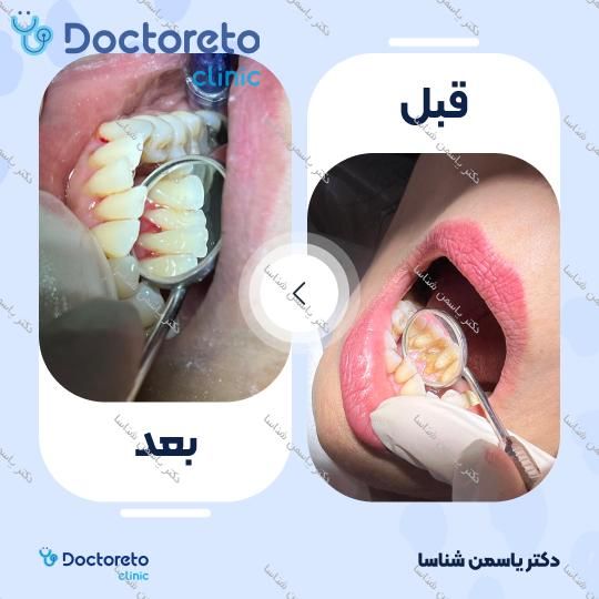 جرم گیری کامل دندان‌های دو فک با بروساژ🦷