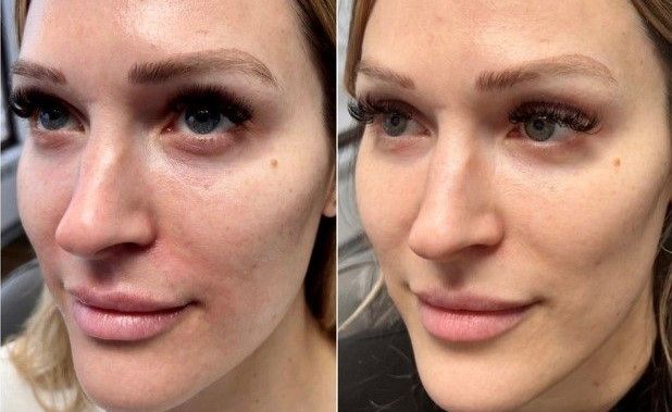 تزریق ژل زیر چشم