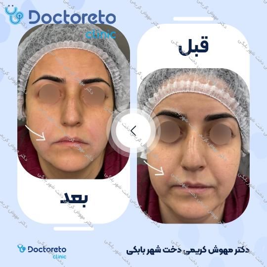 تزریق ژل خط خنده