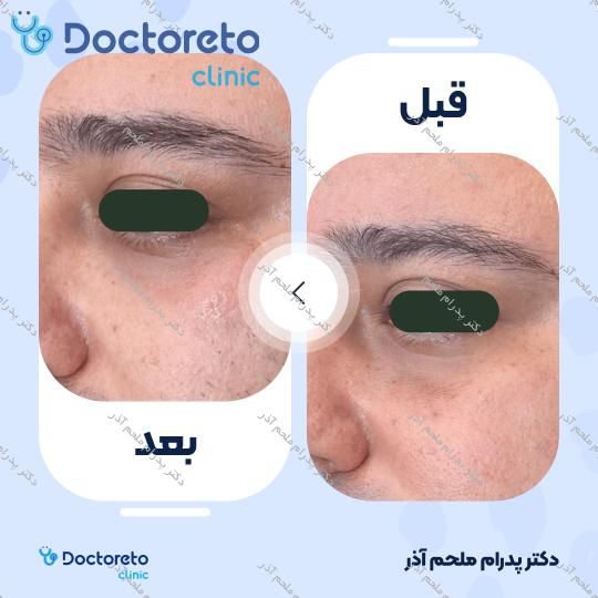 تزریق ژل زیرچشم