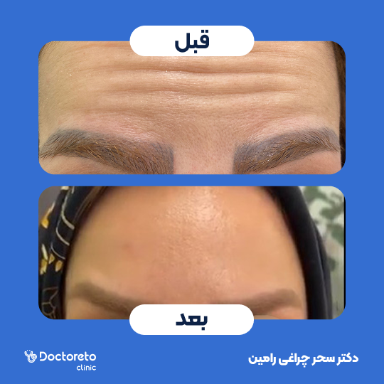 تزریق بوتاکس صورت (پیشانی، خط اخم، پنجه کلاغی)