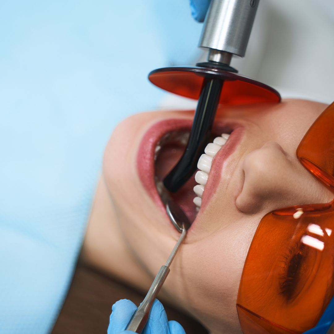 عصب کشی مجدد دندان