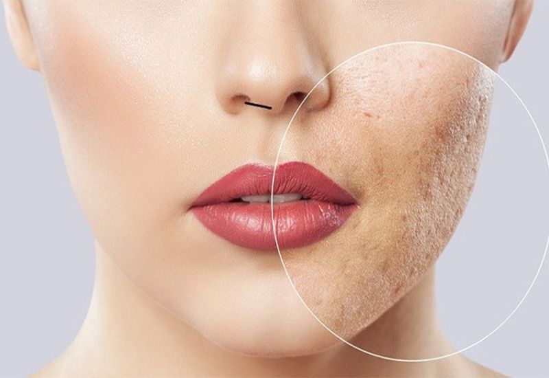 کاهش لک صورت با تزریق مزوتراپی (هر جلسه)