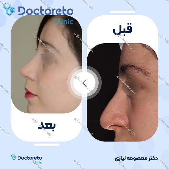 عمل جراحی مجدد زیبایی بینی (رینوپلاستی)