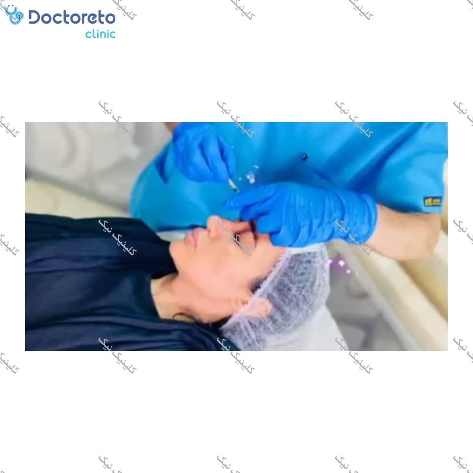 تزریق بوتاکس صورت (پیشانی، خط اخم، پنجه کلاغی)💉
