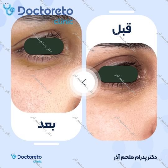 تزریق ژل زیرچشم