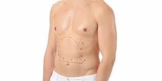 عمل جراحی پیکرتراشی