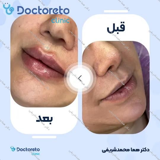 تزریق ژل لب