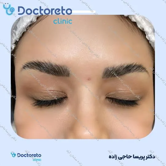 تزریق بوتاکس صورت (پیشانی، خط اخم، پنجه کلاغی)