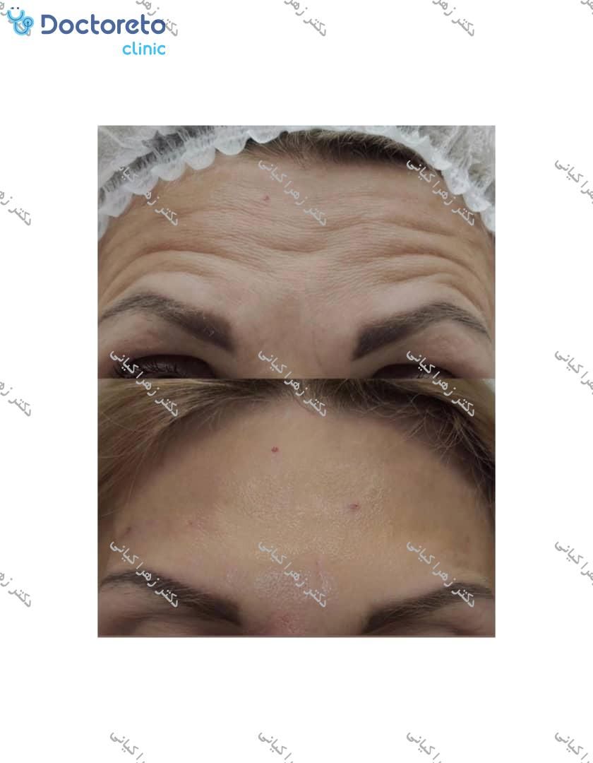 تزریق بوتاکس صورت (پیشانی، خط اخم، پنجه کلاغی)💉