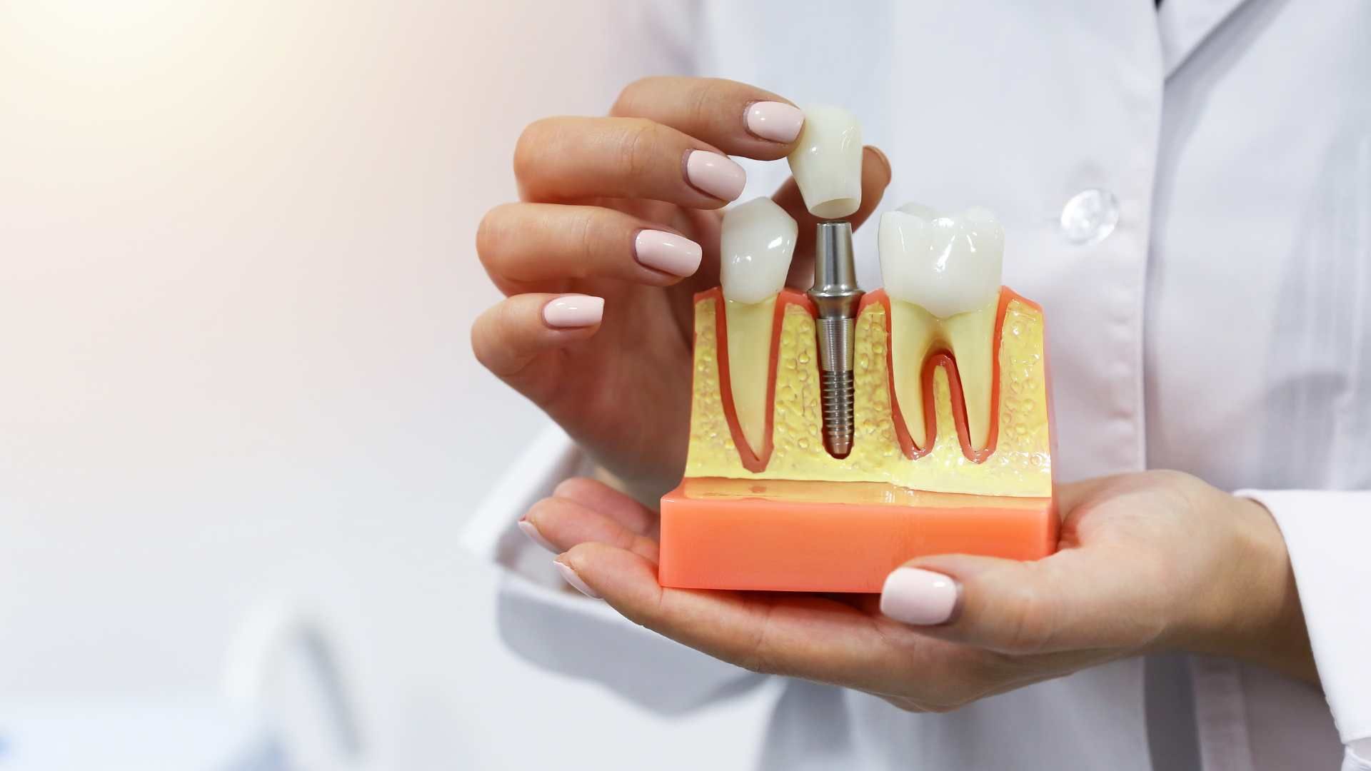 ایمپلنت دندان بدون روکش (هر واحد)