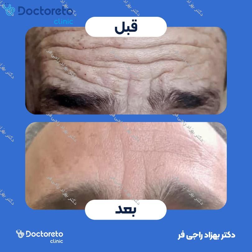 تزریق بوتاکس صورت (پیشانی، خط اخم، پنجه کلاغی)