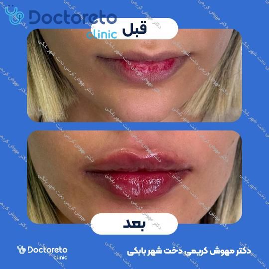 تزریق ژل لب