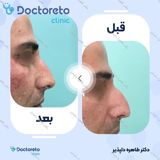 تزریق ژل بینی