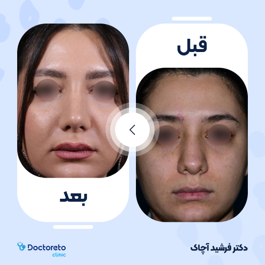 عمل زیبایی بینی گوشتی (رینوپلاستی)