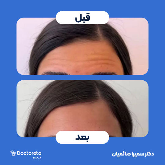 تزریق بوتاکس صورت (پیشانی، خط اخم، پنجه کلاغی)💉