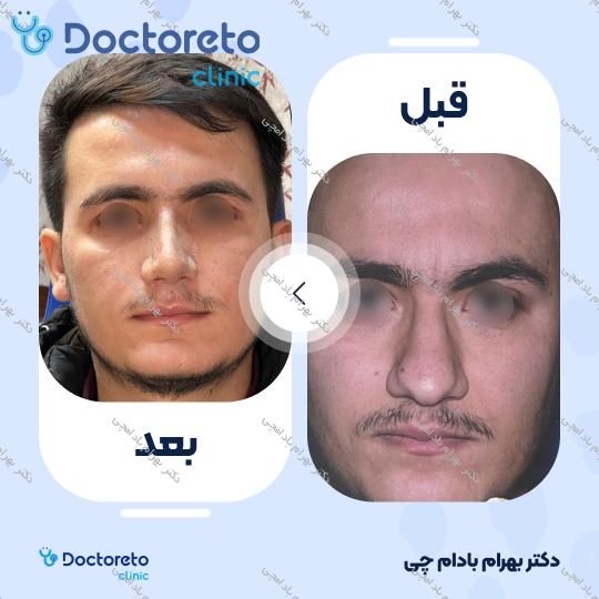 عمل زیبایی بینی گوشتی (رینوپلاستی)