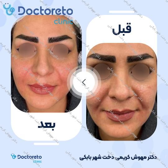 تزریق ژل خط خنده