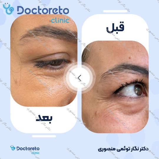 تزریق بوتاکس صورت (پیشانی، خط اخم، پنجه کلاغی)💉