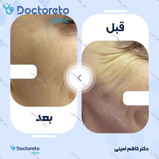 تزریق بوتاکس صورت (پیشانی، خط اخم، پنجه کلاغی)💉