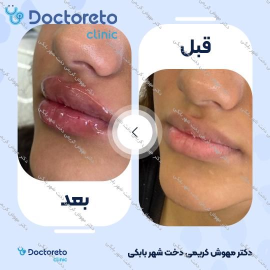 تزریق ژل لب