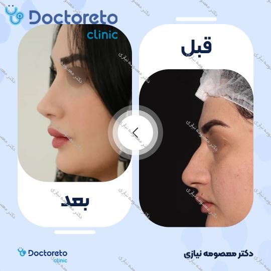 عمل جراحی زیبایی بینی گوشتی (رینوپلاستی)