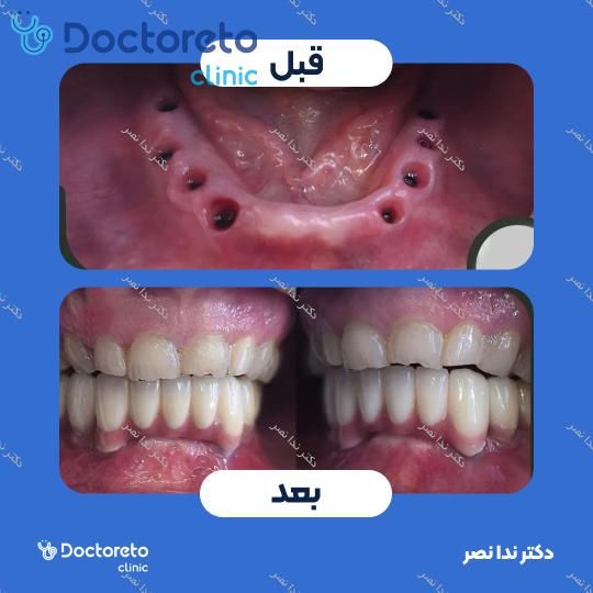 ایمپلنت دندان با روکش (هر واحد)