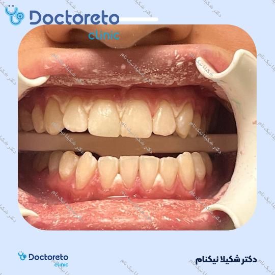 بلیچینگ دندان (سفید کردن دندان)