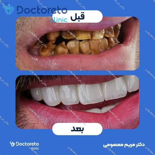 روکش دندان (هر واحد)