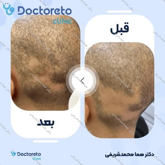 جوانسازی و روشن سازی سیاهی دور چشم با روش پلاسما تراپی