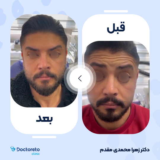 تزریق بوتاکس صورت (پیشانی، خط اخم، پنجه کلاغی)💉