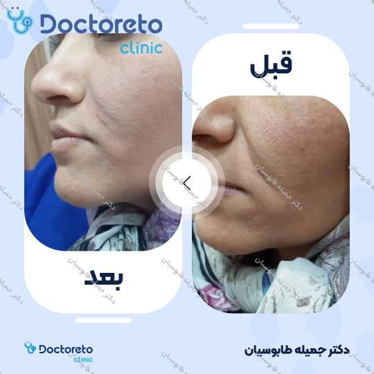 تزریق ژل خط خنده