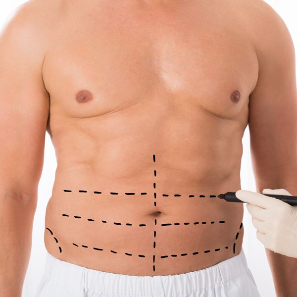 عمل جراحی ابدومینوپلاستی (جراحی زیبایی شکم)