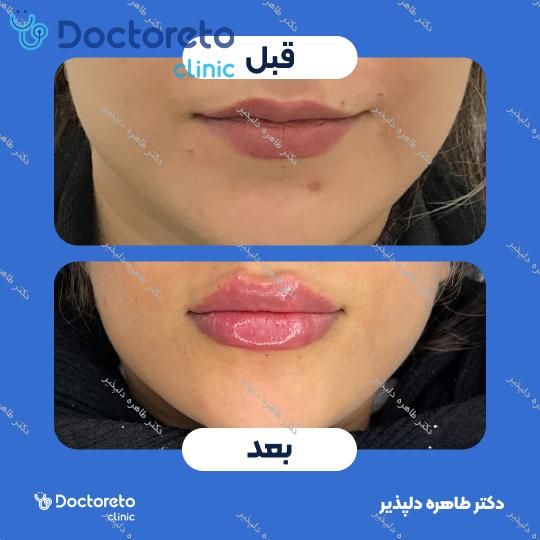 تزریق ژل لب