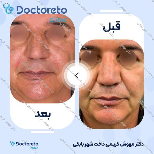 تزریق ژل زاویه فک