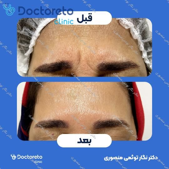 تزریق بوتاکس صورت (پیشانی، خط اخم، پنجه کلاغی)💉