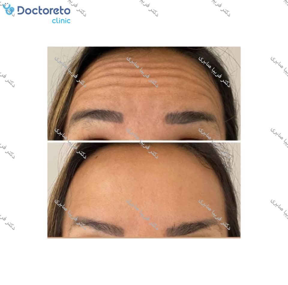 تزریق بوتاکس صورت (پیشانی، خط اخم، پنجه کلاغی)💉