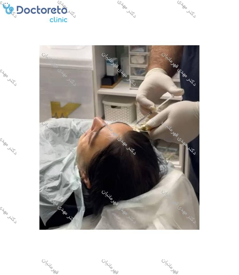 تزریق بوتاکس صورت (پیشانی، خط اخم، پنجه کلاغی)💉