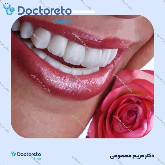 ونیر کامپوزیت (هر واحد)