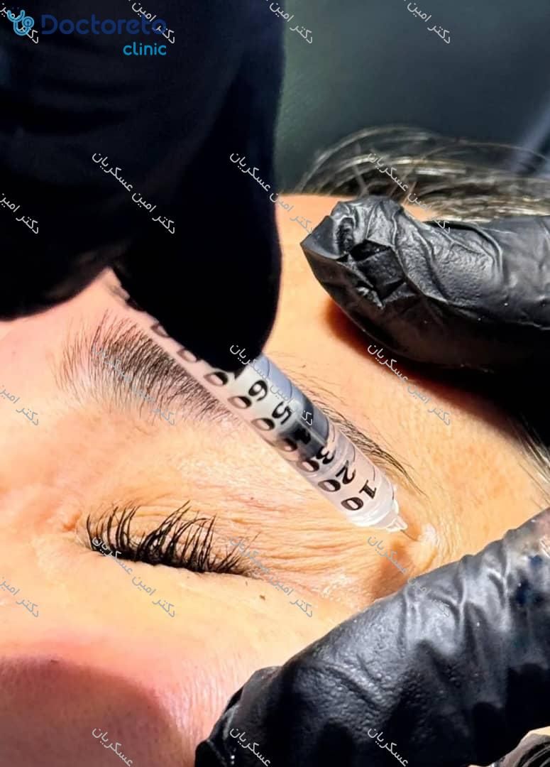 تزریق بوتاکس صورت (پیشانی، خط اخم، پنجه کلاغی)💉