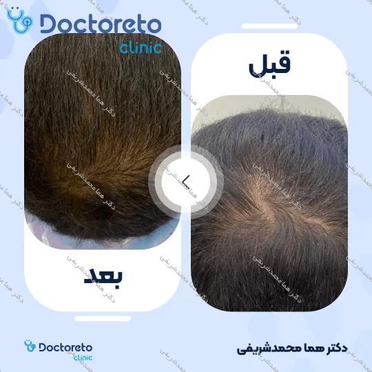 جوانسازی و روشن سازی سیاهی دور چشم با روش پلاسما تراپی