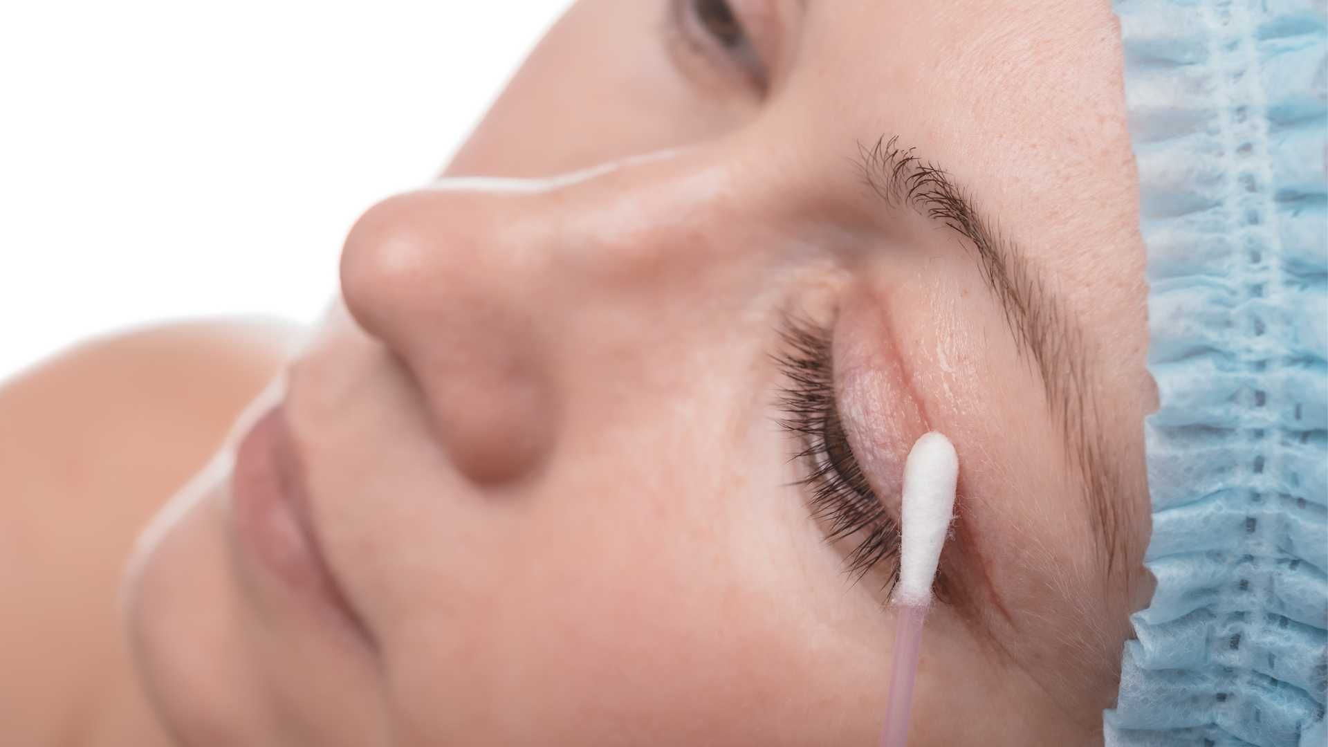 رفع افتادگی پلک به روش جراحی (بلفاروپلاستی)