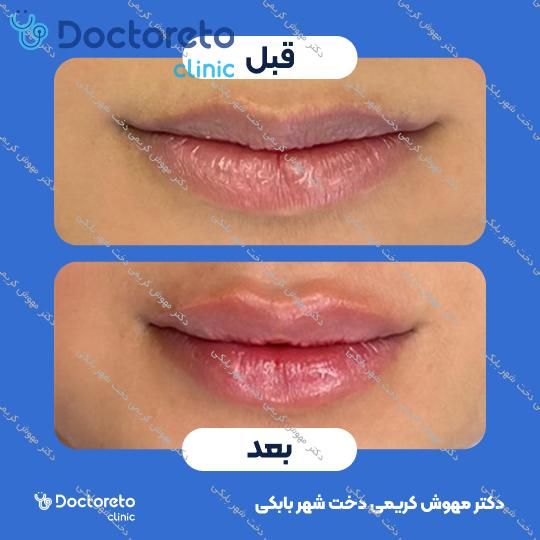 تزریق ژل لب